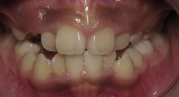 Before